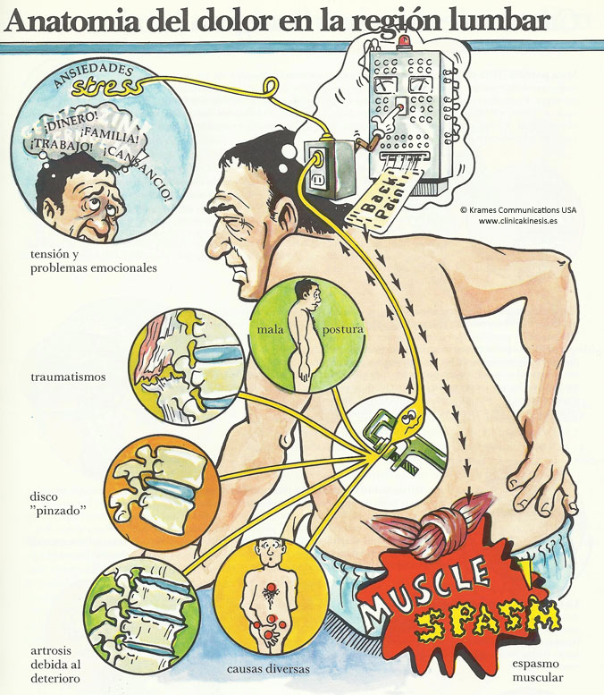 Anatomía del dolor en la región lumbar. Clínica Kinesis